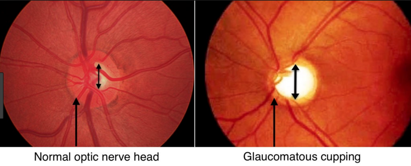 Норма зрительного нерва. Офтальмоскопия глазного дна. Зрительный нерв глаукома. Глаукома диск зрительного нерва. Открытоугольная глаукома на офтальмоскопии.